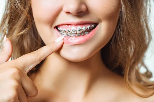 Top Reasons To Consider Getting Invisible Braces